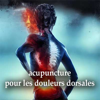 acupuncture pour le mal de dos